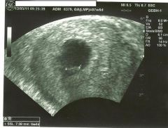 Schwer erkennbar: Unten in der Fruchthöhle sitzt der Embryo!