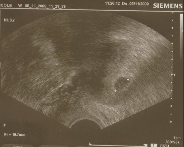 1. Ultraschallbild vom 5. November 2009 in Woche 5+4.