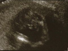 Ultraschallbild vom 30. Dezember 2009. Zu sehen ist der kleiner Puller *G*