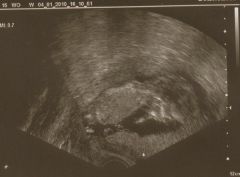 Ultraschallbild vom 04. Januar 2010.
