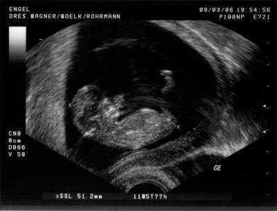 Mehr Informationen zu "Ultraschall in der Schwangerschaft"